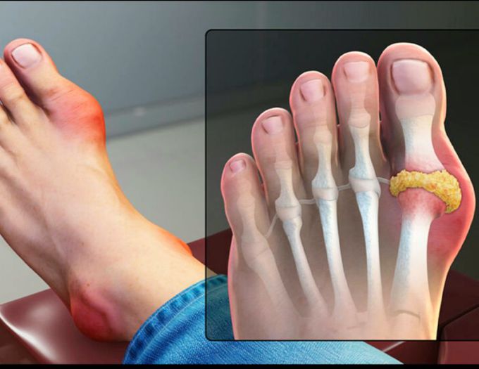 Gout Disease