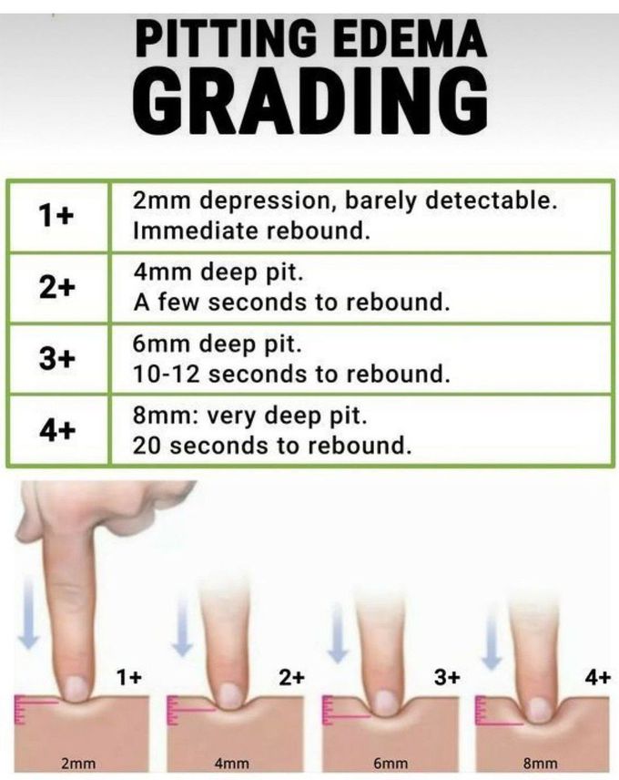 Pitting Edema