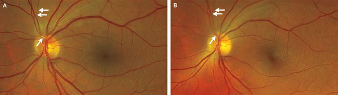Migrating Emboli in Branch Retinal Artery Occlusion