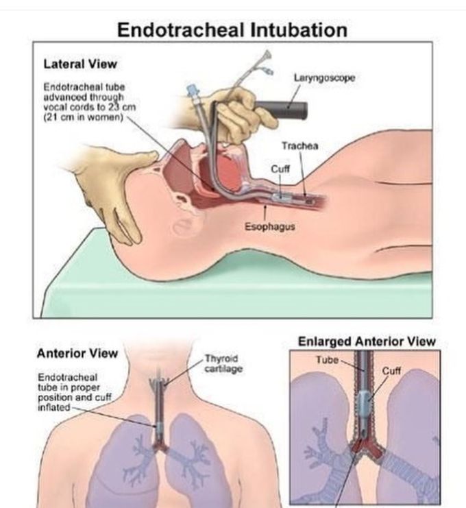 Intubation