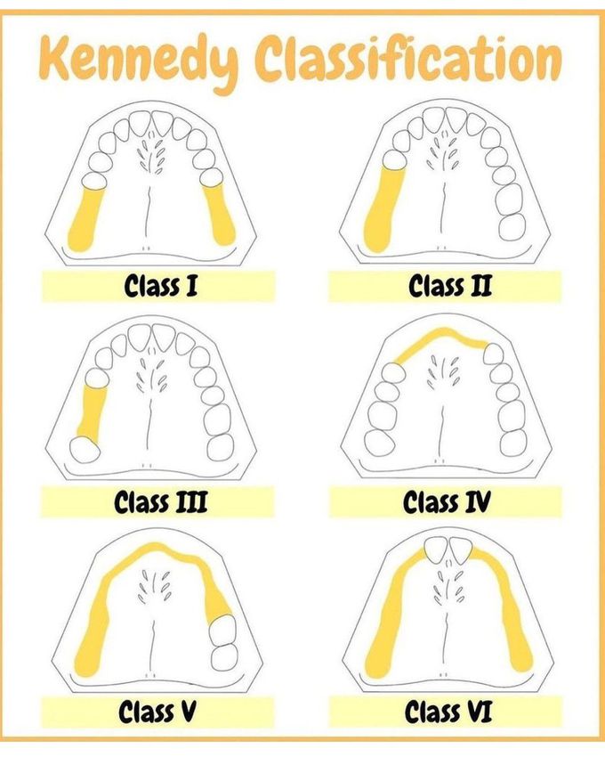 Kennedy Classification