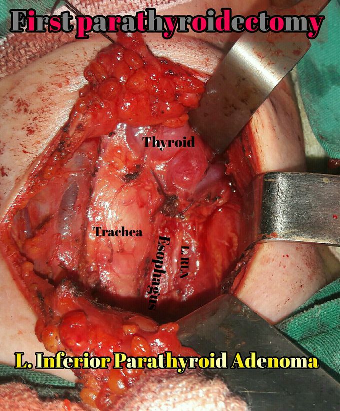 Parathyroid adenoma