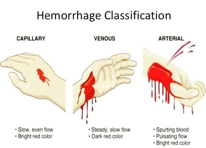 Hemorrhage classification