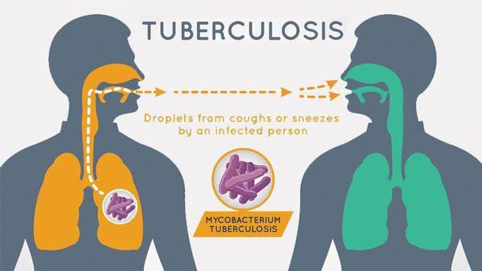Causes of TB