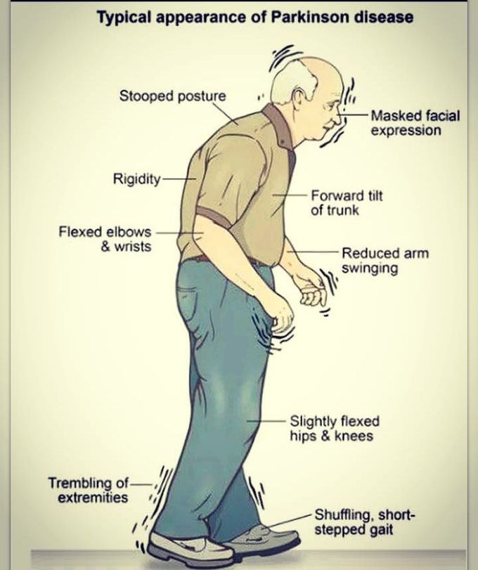 Parkinson's disease