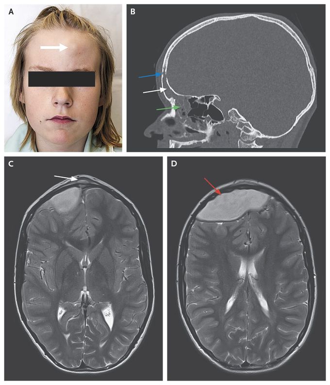 Frontal Sinusitis Causing Epidural Abscess and Puffy Tumor