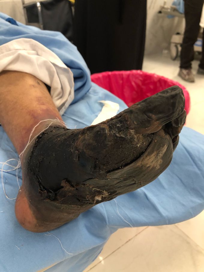 Dry gangrene