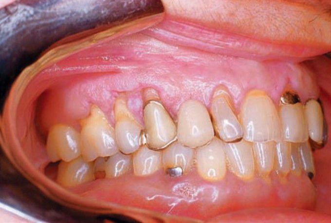 Abrasion of teeth