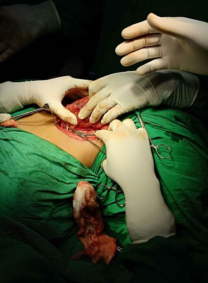 Preservation of recurrent laryngeal nerve during subtotal thyroidectomy