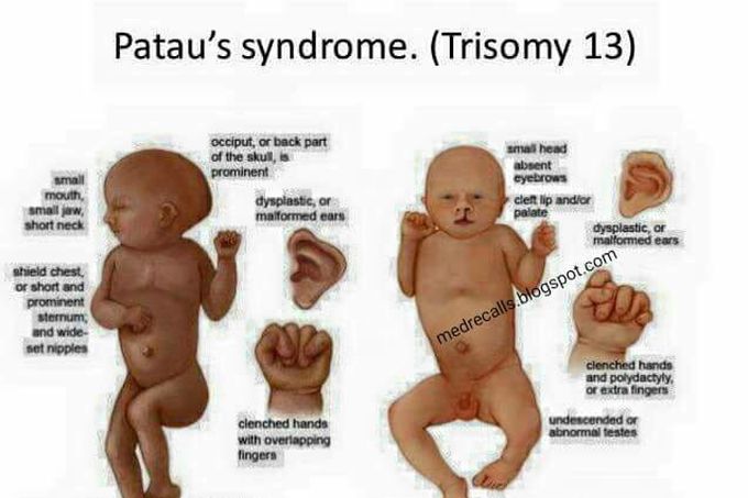 Abnormally of Trisomy 13