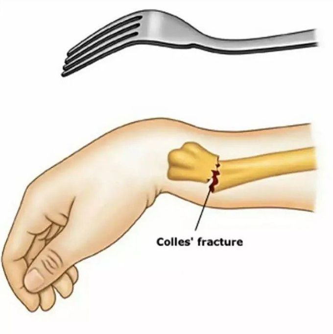 Colles Fracture