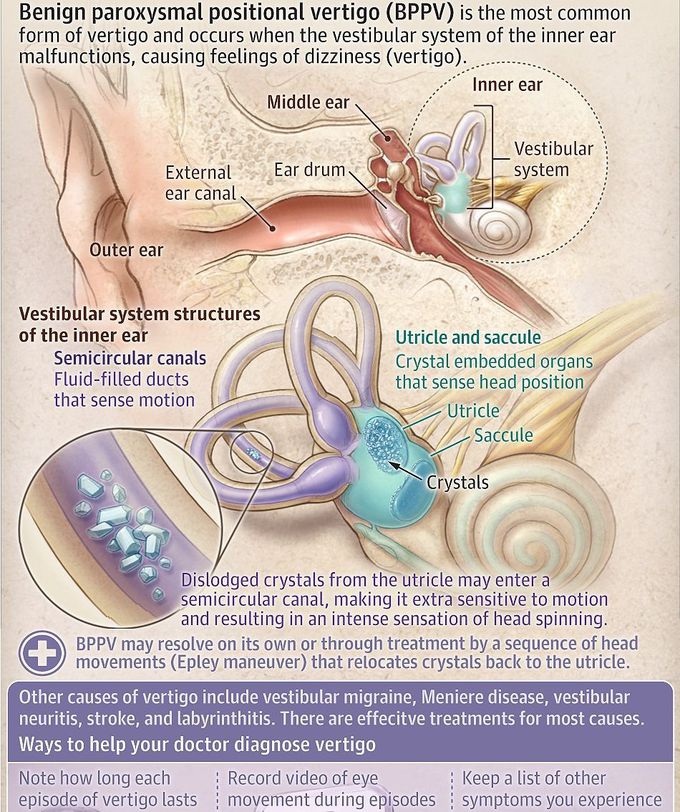 Benign paroxysmal positional Vertigo (BPPV)