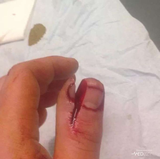 Thumb lac