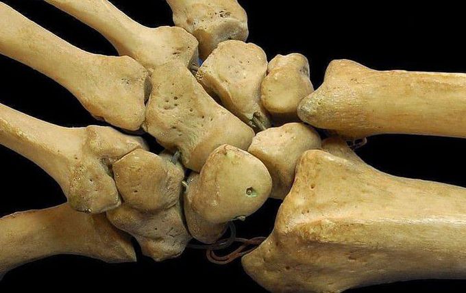 Carpal Bones