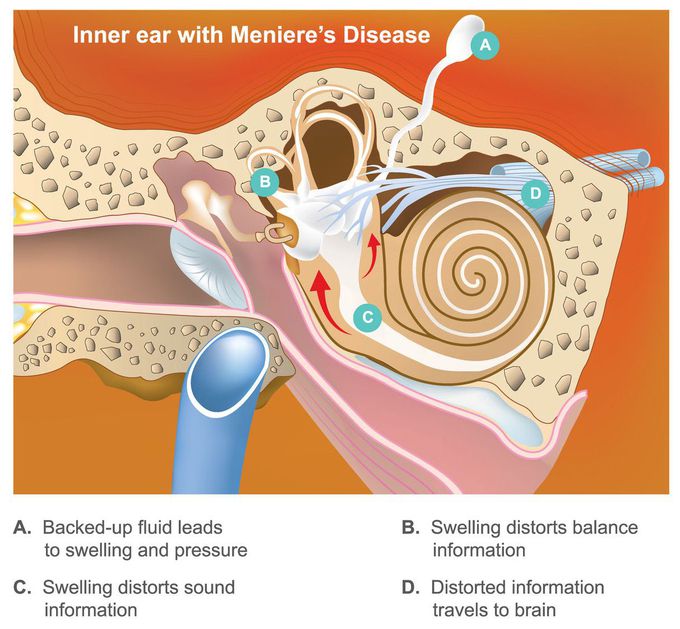 Meniere's disease
