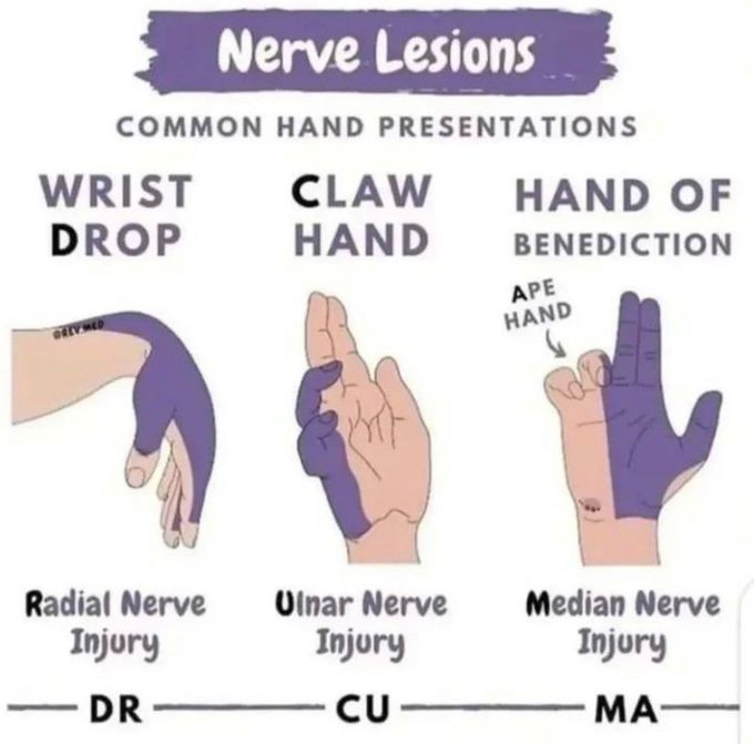 Nerve Lesions