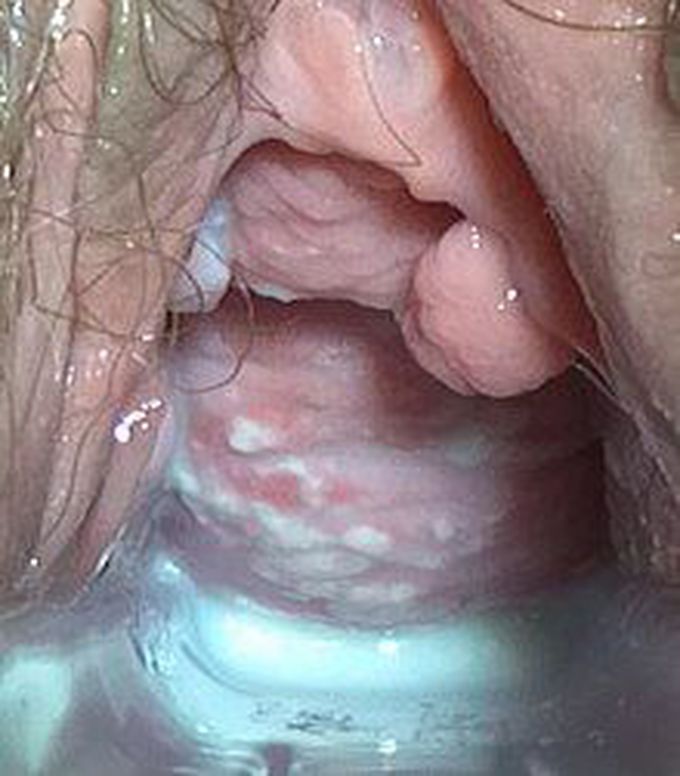 Treatment of vaginal candidiasis