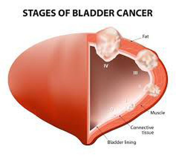 Bladder cancer