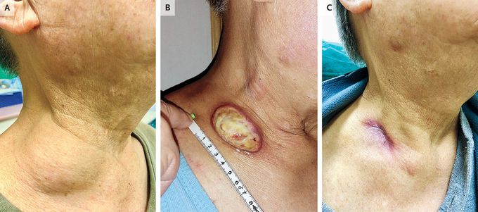 Paradoxical Reaction in the Treatment of Scrofula
List of authors