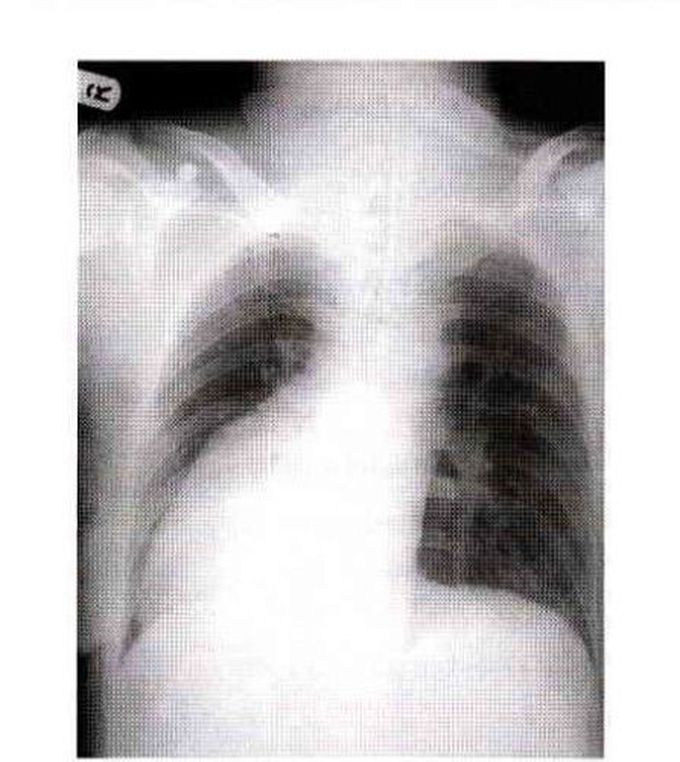 Dextrocardia