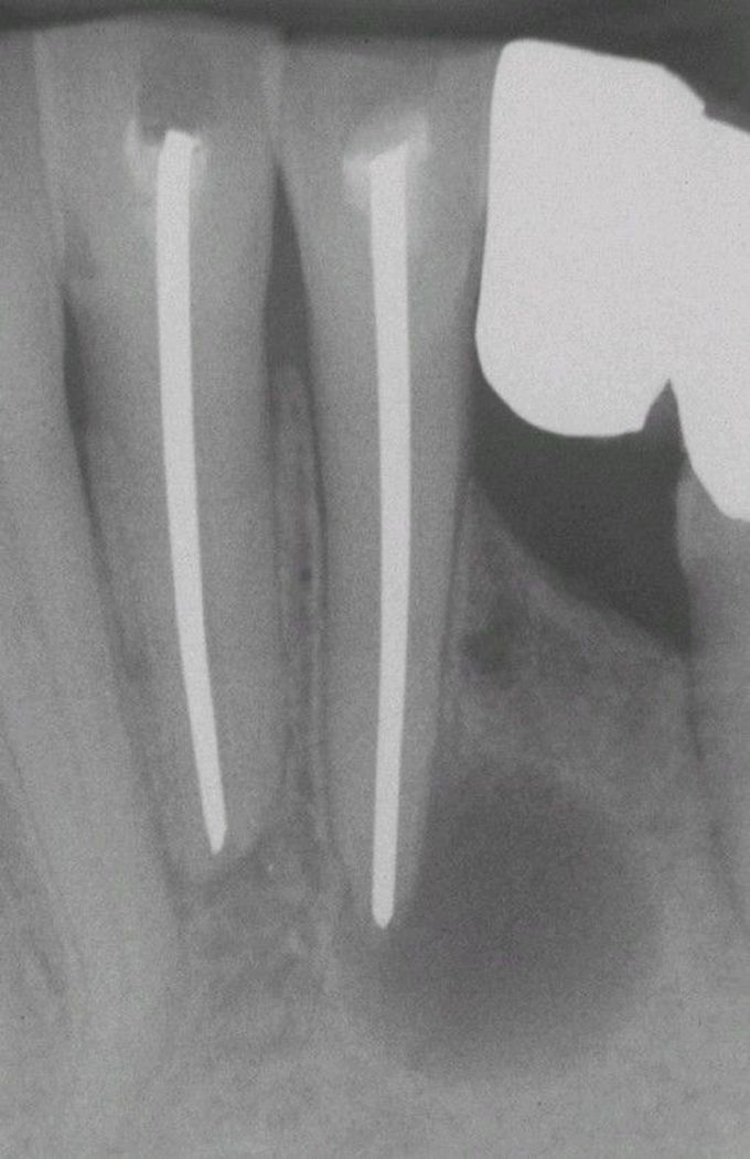 Periapical Cyst