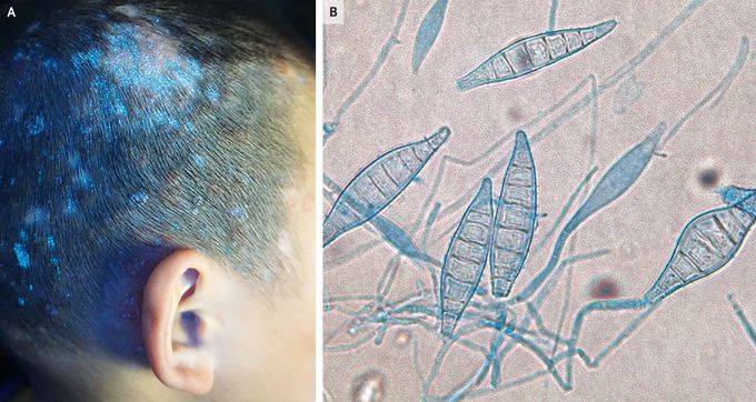 Tinea Capitis Due to Microsporum canis - MEDizzy