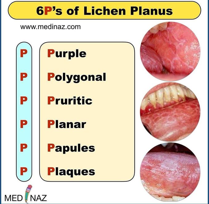 6Ps of Lichen Planus - MEDizzy