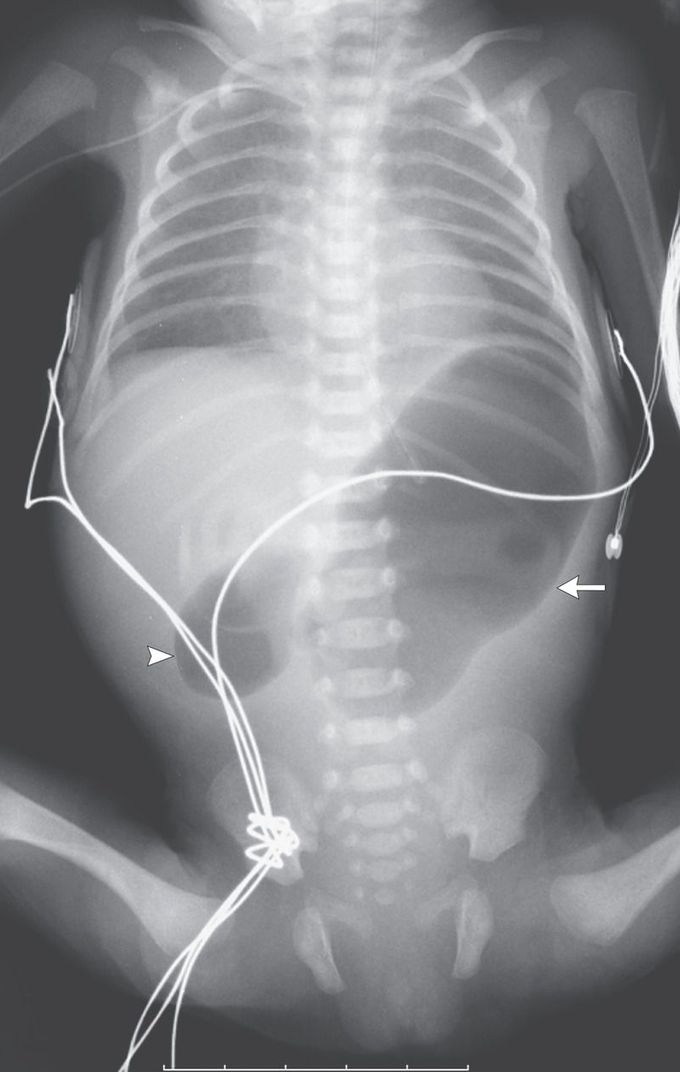 Congenital Duodenal Obstruction and Double-Bubble Sign