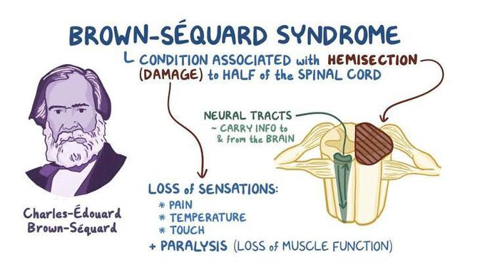 Symptoms of brown sequard syndrome