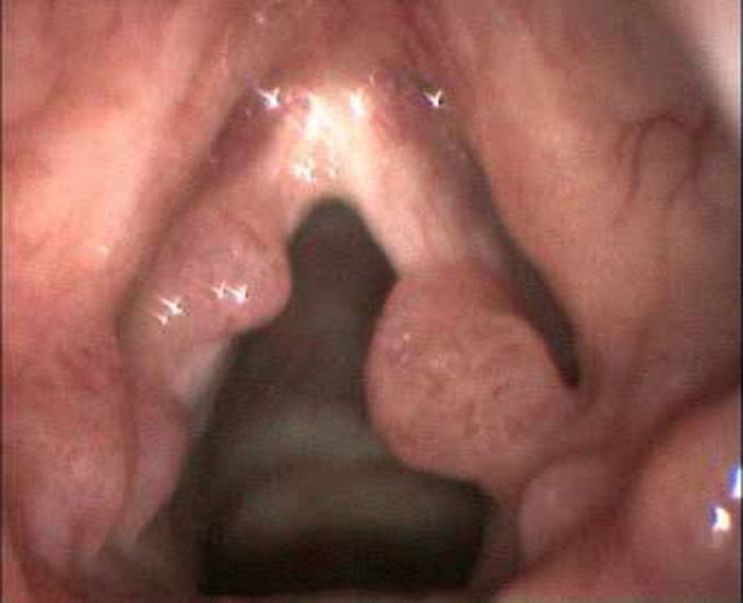 Laryngeal papilloma