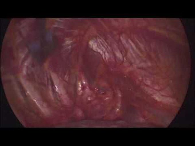 A New Microsurgical Approach for the Treatment of Primary Spontaneous Pneumothorax