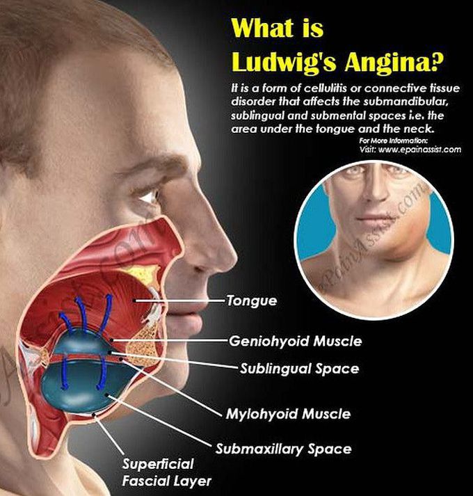 Cause of Ludwig Angina