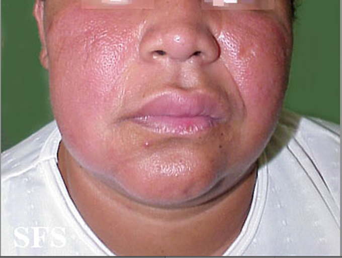 Symptom of Melkersson-Rosenthal syndrome