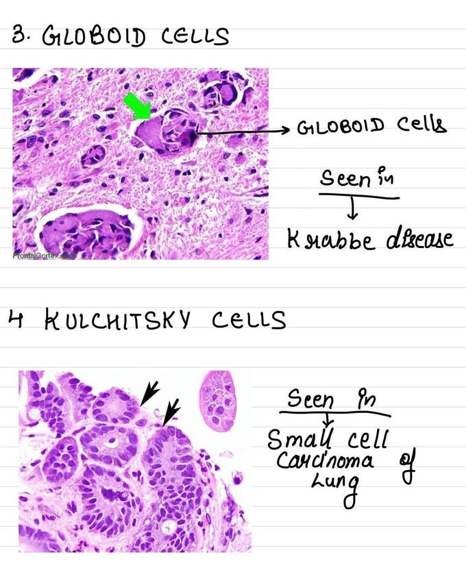 Globoid cells and kulchitsky cells medizzy