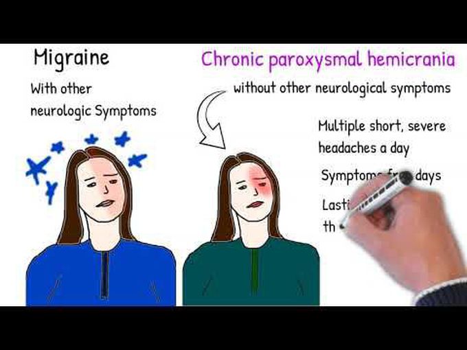 Hemicrania vs migraine