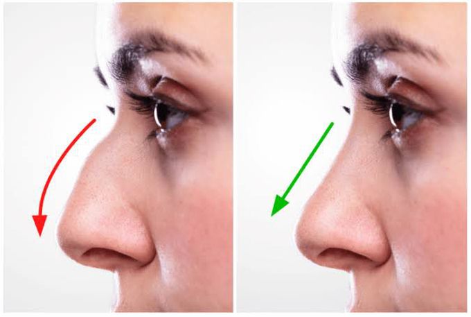 Rhinoplasty