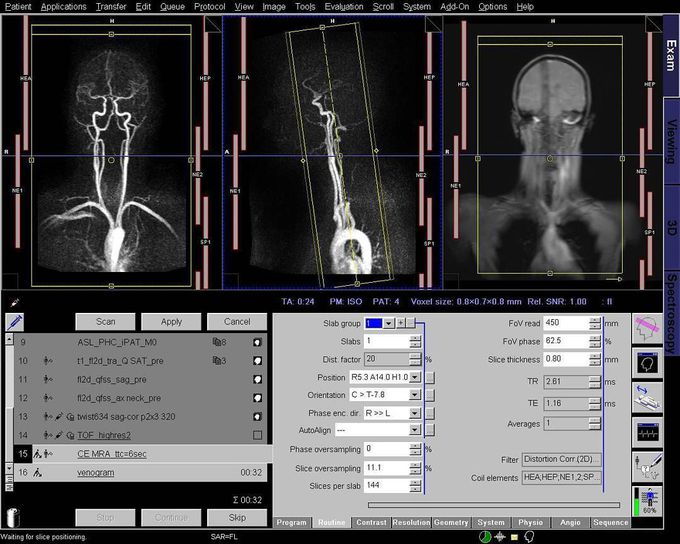 Carotid Contrast-Enhanced Magnetic Resonance Angiography on a Siemens MRI System!