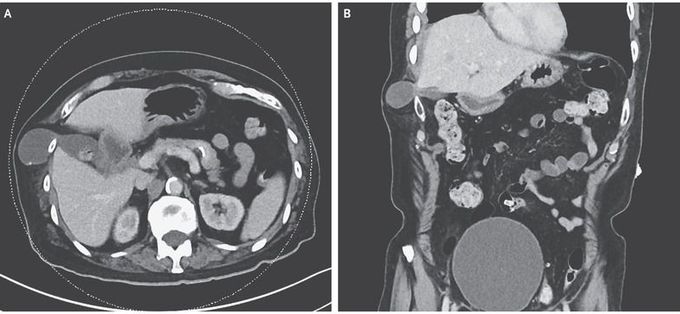 Transdiaphragmatic Intercostal Herniation of the Gallbladder