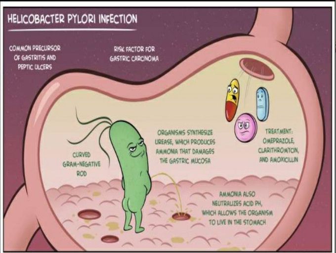 Ammonia helps H.pylori survive in acidic stomachs.