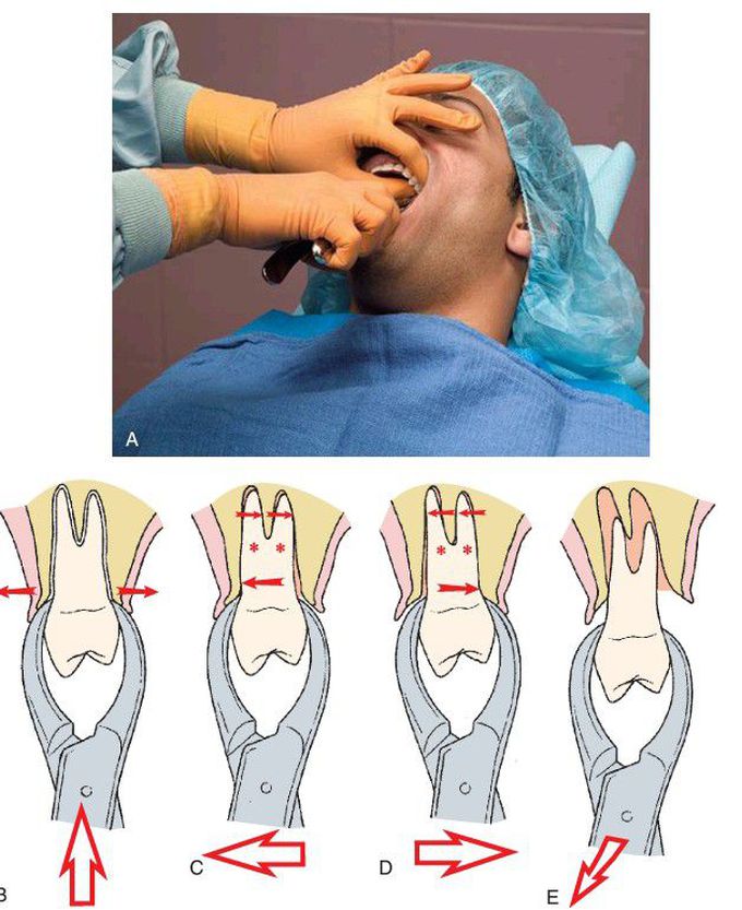 Maxillary premolars extraction