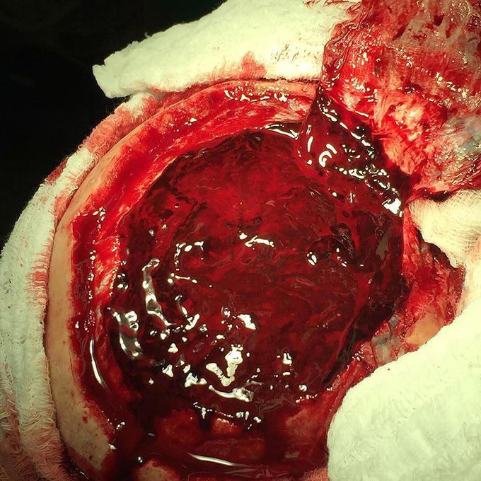 Gigantic acute subdural hematoma!! 