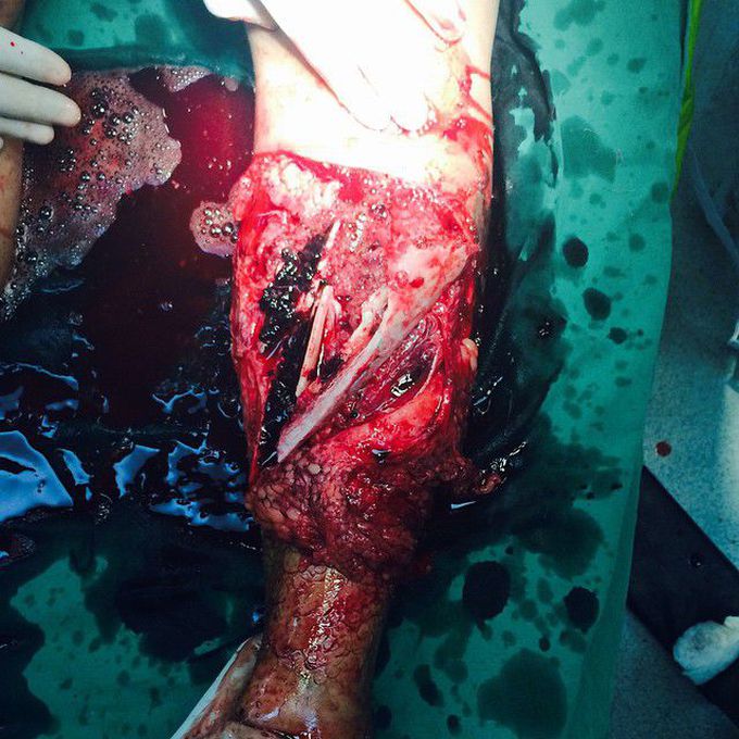 Crush injury