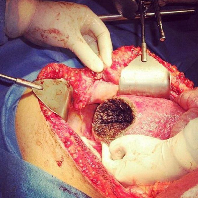 Hepatocarcinoma
