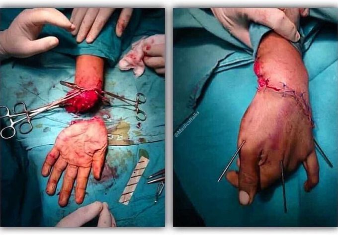 Reconstructive surgery to attach a severed hand!! 