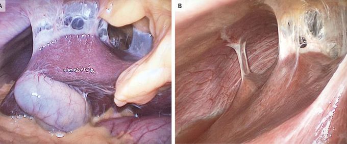 Fitz-Hugh–Curtis Syndrome