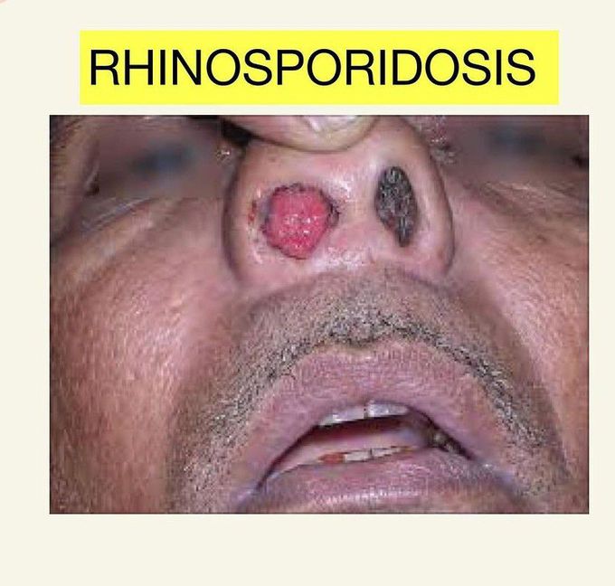 Rhinosporidiosis