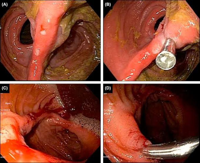 Possible causes of rectal bleed