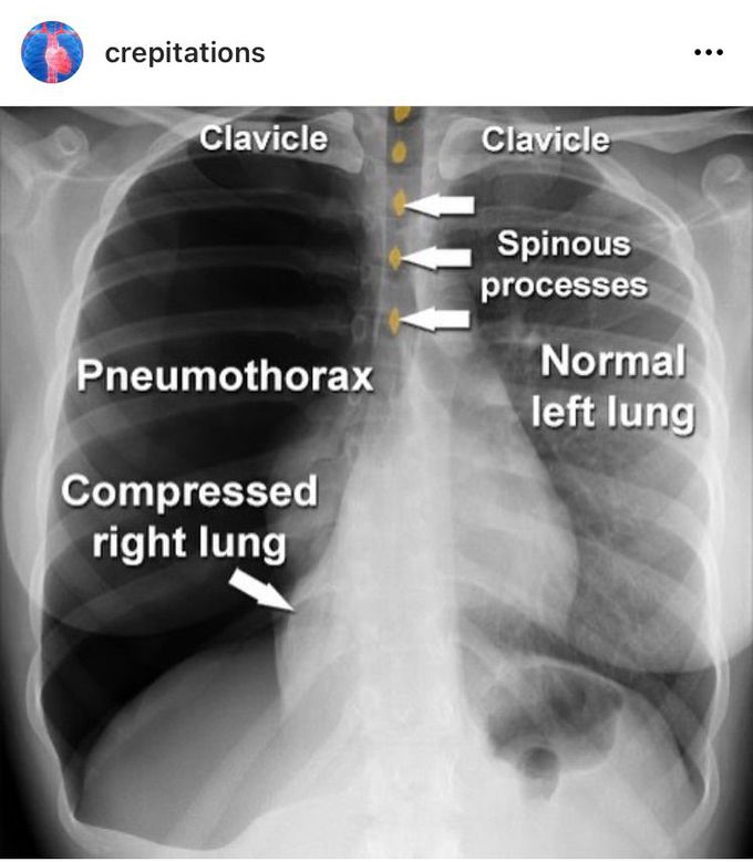 Pneumothorax