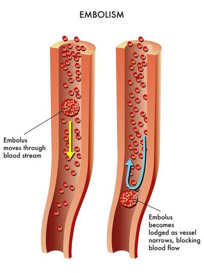 Embolus