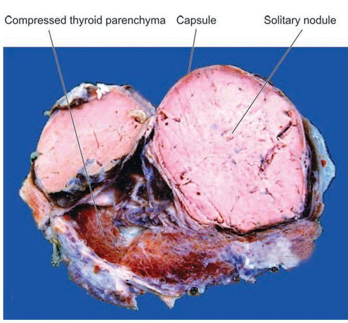 Follicular adenoma thyroid